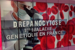 Journée mondiale de lutte contre la drépanocytose: une maladie désormais bien prise en charge en Guyane