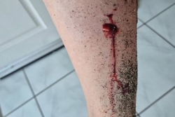 Mordue au mollet par un chien : la promenade d'une touriste sur la plage vire au cauchemar