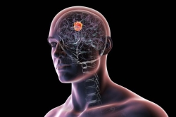 Pour mieux soigner les cancers, les spécialistes demandent à inclure davantage les populations ultramarines dans les essais cliniques