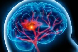 En Guadeloupe, 2 à 3 personnes sont victimes d’un AVC chaque jour : une journée de sensibilisation pour sauver des vies