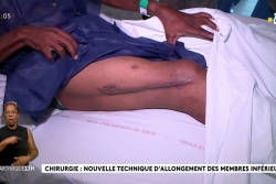 Première dans la Caraïbe : le CHU de Martinique réalise une opération d’allongement du fémur