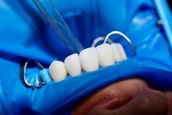 "Une première", le CHU de Martinique réalise une implantologie dentaire sur une reconstruction osseuse