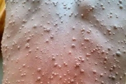 Ce jeudi 8 janvier, un cas de Mpox, en provenance de Madagascar a été confirmé à Mayotte