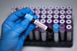 Symptômes, vaccin, transmission : ce qu'il faut savoir du Mpox, la variole du singe, après la détection d'un premier cas à Mayotte