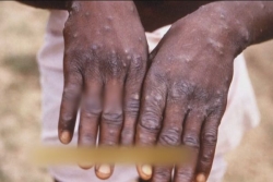 Variole du singe : l'ARS de La Réunion demande aux voyageurs en provenance de Madagascar de redoubler de vigilance 