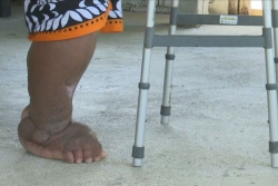 Filariose : Futuna se prépare pour une deuxième campagne de traitement de masse