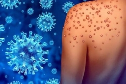 MPOX : premier cas confirmé à La Réunion, l’ARS renforce la vigilance      