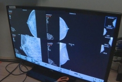 Le dépistage du cancer du sein toujours en retard en Outre-mer