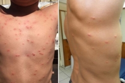 2 cas de dermatite du surfeur signalés à Papara