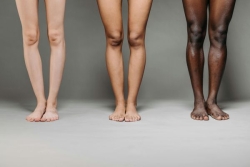 Les peaux noires et foncées, grandes oubliées de la dermatologie en France ?