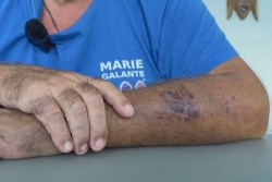 TEMOIGNAGE. Récit de la victime d’un home jacking à Marie-Galante : "J’ai ramassé, à la tête, au bras..."