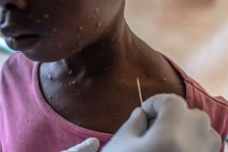 MPox : 20 cas recensés à La Réunion depuis le début de l'année, principalement importés de Madagascar. L'ARS appelle à la vigilance 