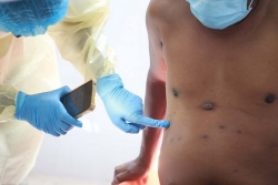 Madagascar : 1 000 nouveaux cas de Mpox notifiés et 9 décès depuis le début du mois de juillet