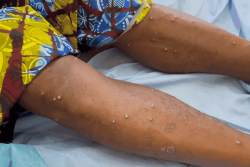 Mpox à Mayotte : 43 cas du virus recensés